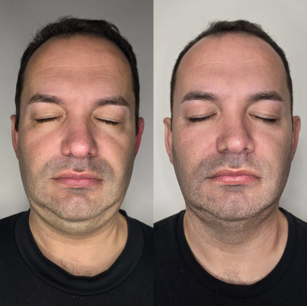 HIFU — Antes / Depois